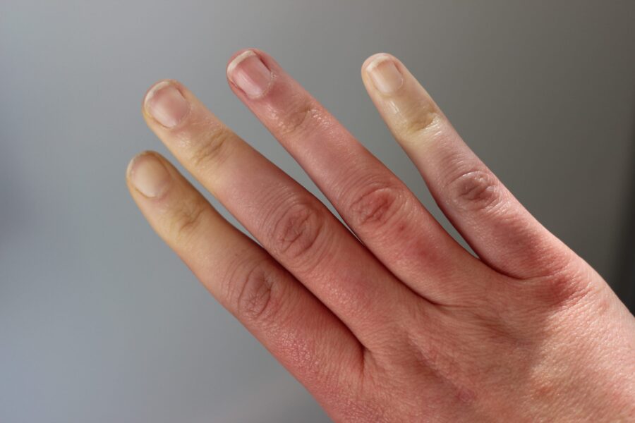 Image de :Raynaud’s disease : symptoms and treatments