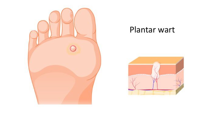 Image de :How do I treat my plantar warts at home?